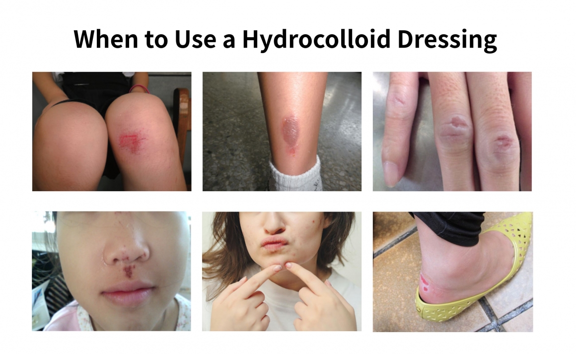 When to Use a Hydrocolloid Dressing TRIDA IGIBAN When to Use a Hydrocolloid Dressing TRIDA IGIBAN